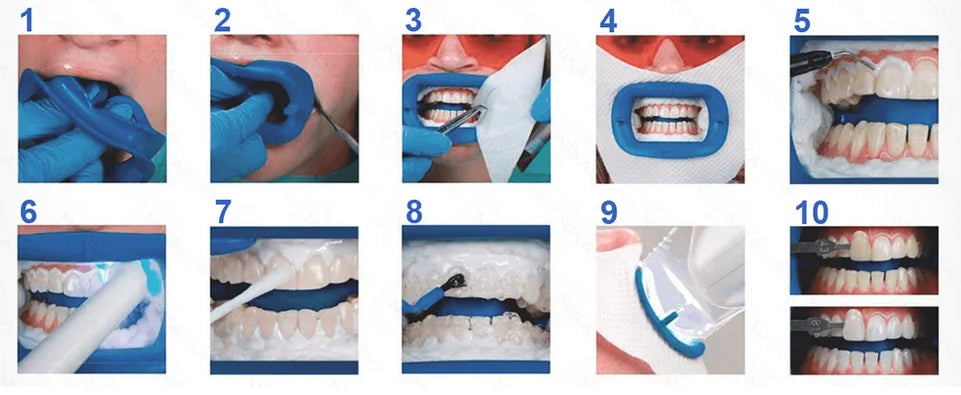 Professional Teeth Whitening Kit Chairside Light-Activated, 2 Person Procedures J14514